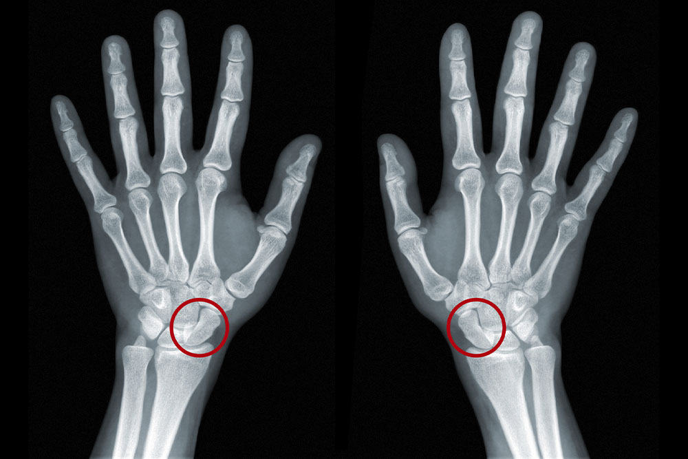 Radiografia de duas mãos onde o escafóide, um pequeno osso do punho, está destacado em vermelho em cada imagem.